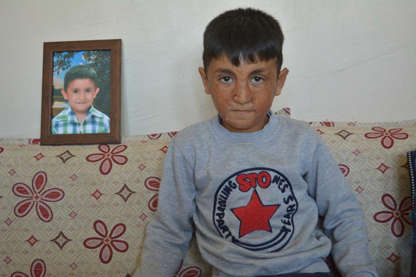 Yüzü ve elleri yanan küçük çocuk yardım bekliyor Yüzü ve elleri yanan küçük çocuk yardım bekliyor
